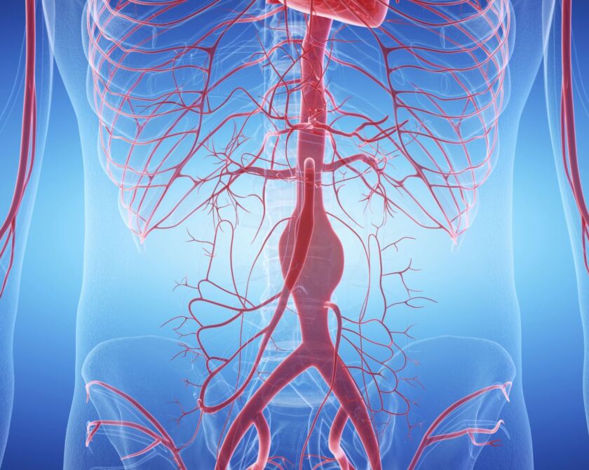 Illustration der Arterien im Körper mit Fokus auf eine aufgeblähte Arterie - Aneurysma