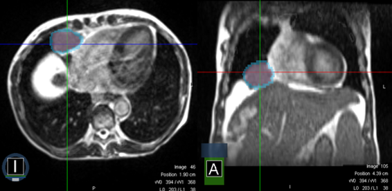MRI Echtzeitaufnahme eines Lungentumors