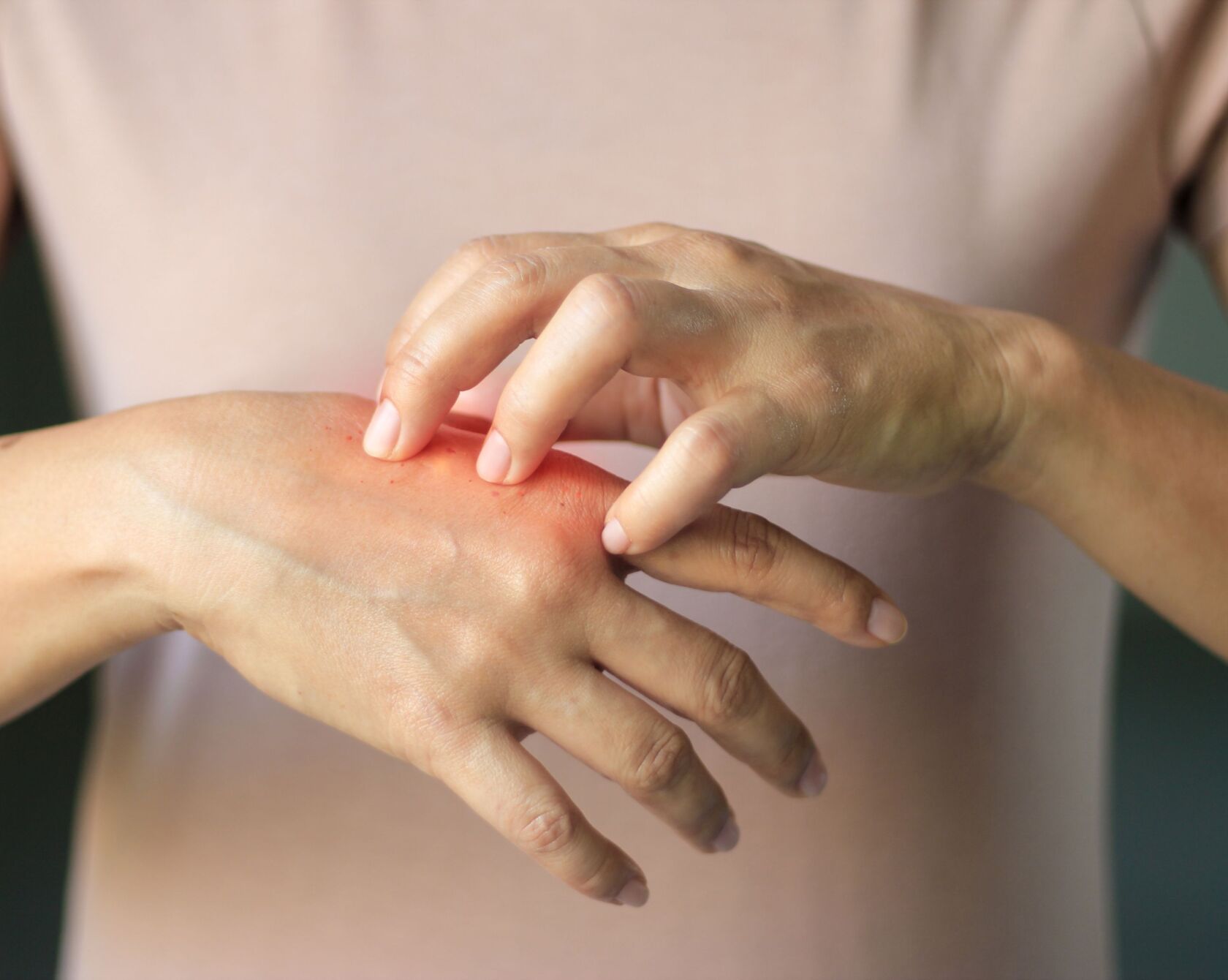 Frau kratzt sich Handrücken