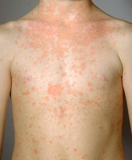 Upper body of a child with extensive hives.