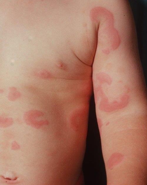 Figure hives