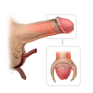 Illustration eines Penis bei dem ein Eingriff durchgeführt wird