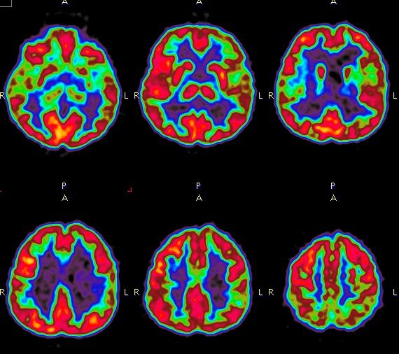 Distribution of the tracer 18F-FDG in the brain.