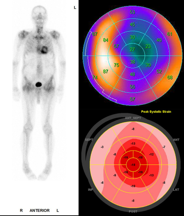 74-year-old patient with hypertrophic left ventricular myocardium. In the differential diagnosis, with known hypertension, hypertensive heart disease was possible, but based echocardiography an amyloidosis was suspected. The whole-body skeletal scintigraphy (left) clearly shows accumulation of the bone tracer in the myocardium. The local enrichment in the left ventricular myocardium (shown as a so-called polar plot, top right) is found mainly septal and lateral, whereas the apex is spared. The scintigraphically proven enrichment coincides clearly well with the echocardiographic strain map (bottom right). Since there was no evidence of AL amyloidosis in the electrophoresis, a clear diagnosis of cardiac ATTR amyloidosis could be made.