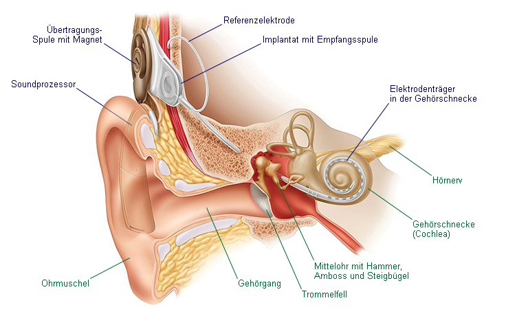 Illustration eines Cochlea Implantats mit Beschriftungen