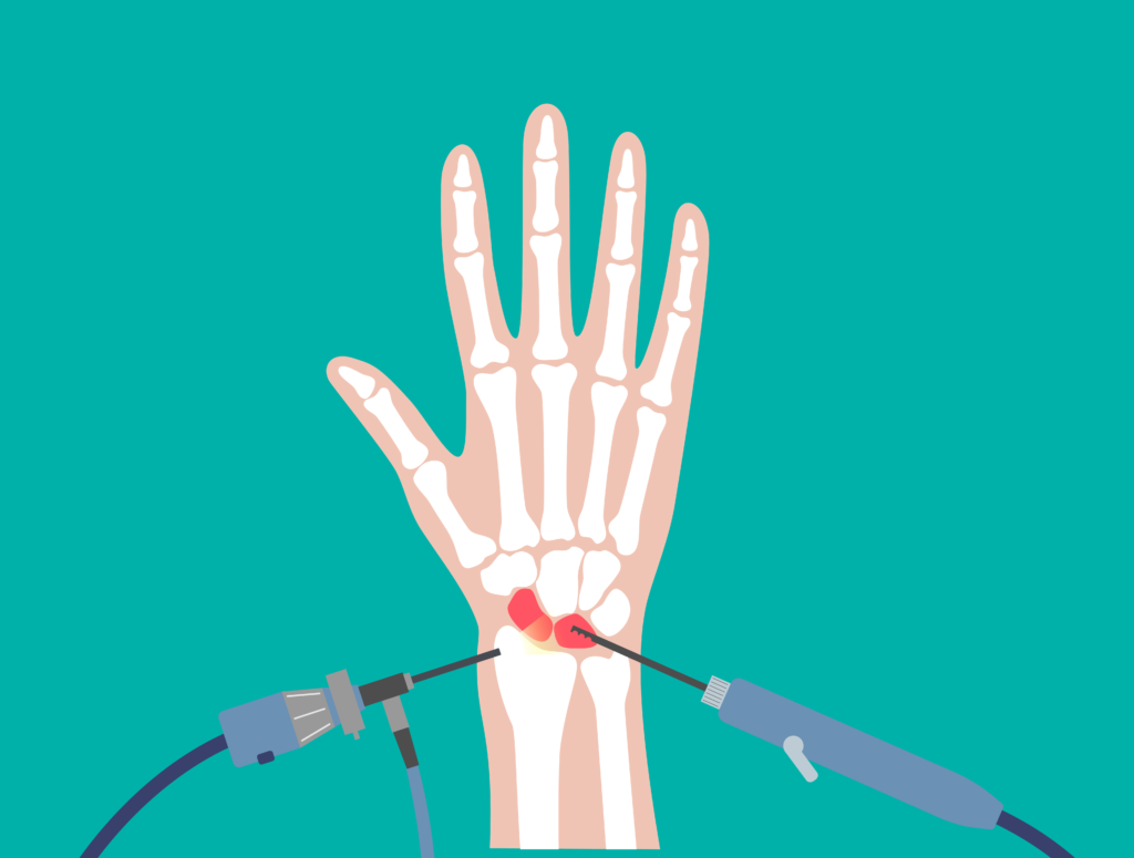 Illustration einer Operation am Handgelenk