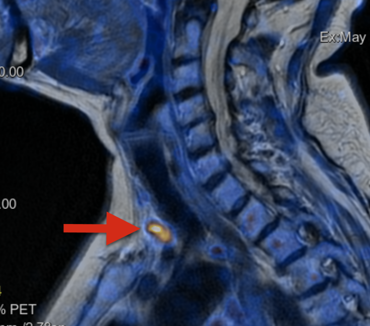 MRI Aufnahme eines Nebenschilddrüsenadenom