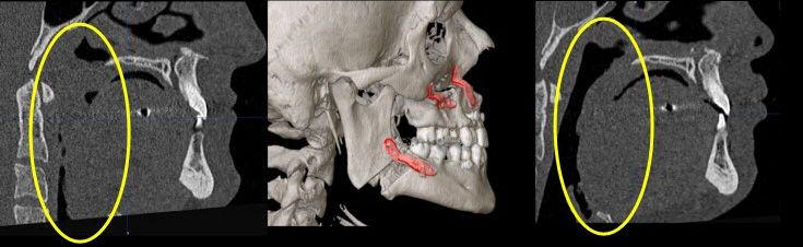 MRI Aufnahmen von einer Kieferfehlstellung