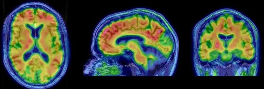 MRI Aufnahmen des Gehirns mit Alzheimer