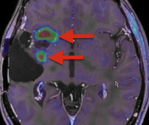 MRI Aufnahme eines Gehirns mit Astrozytom