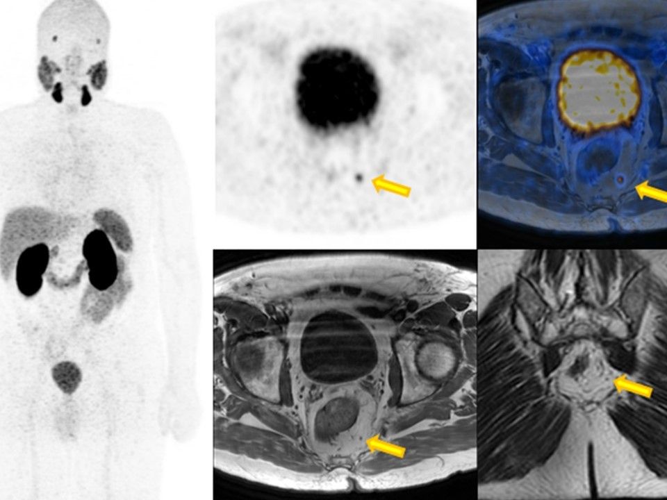 Coronary MIP uptake in this 67-year-old patient provides a first overall view. After a radical prostate resection in 2013, the PSA increased again to currently 0.22 ng/ml. Axial fused images demonstrate focal PSMA enhancement in a pararectal lymph node as small as 3 mm in diameter (yellow arrow). This is therefore, despite the small size suspicious for a lymph node metastasis.