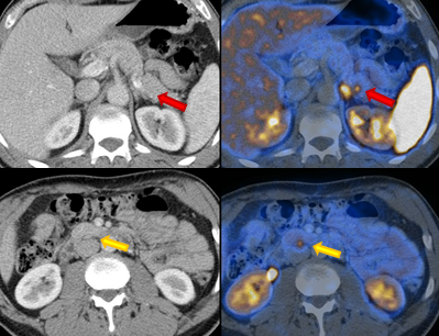 On the axial fused images, a focal DOTATATE accumulation in the pancreas can be localized (red arrow), which corresponds to a small neuroendocrine tumor that could not be delineated with the CT. There is also a lymph node metastasis dorsal to the pancreas (yellow arrow).