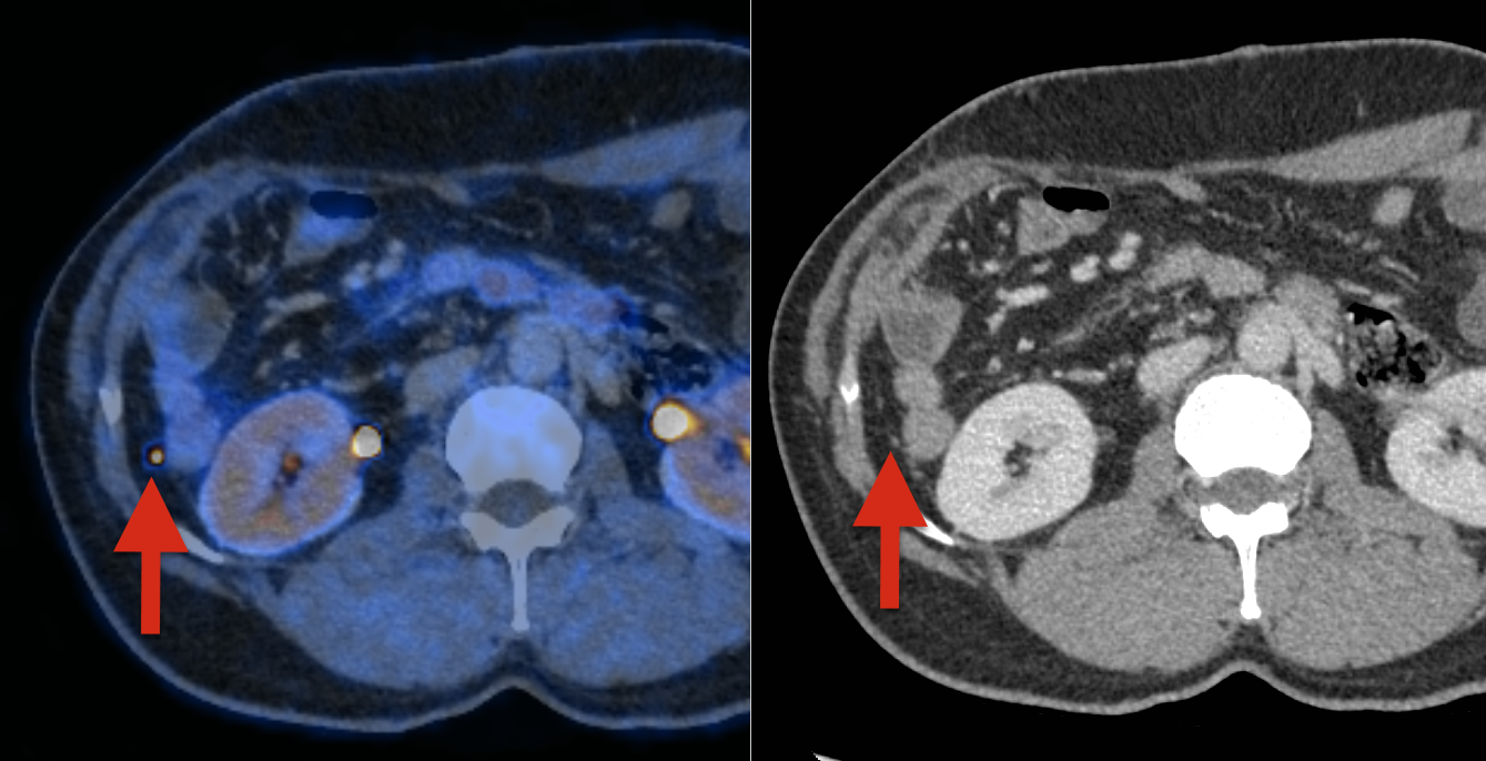 MRI Aufnahme des Körperinnern mit Metastasen