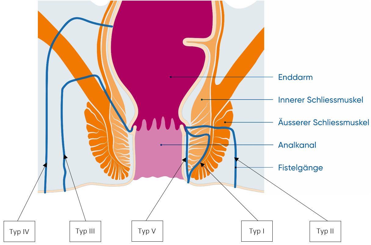 Illustration of anal fistula