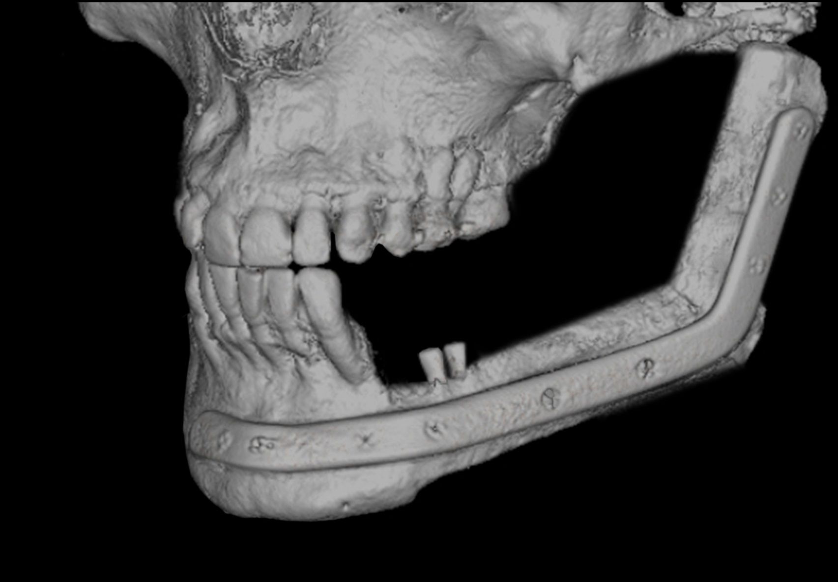 3D CT einer patientenspezifischen Fibularekonstruktion.