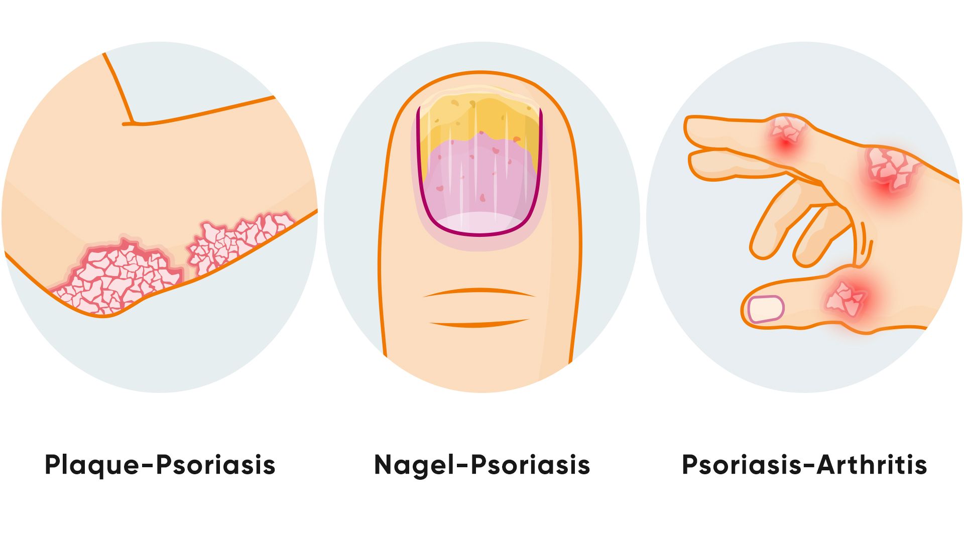 Illustration der Symptome bei Psoriasis (Schuppenflechte)