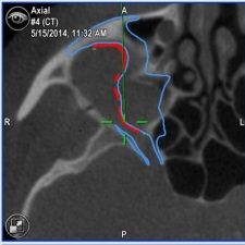 MRI Aufnahme eines Kiefers mit Trauma