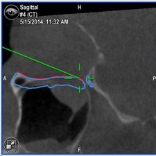MRI Aufnahme eines Kiefers mit Trauma