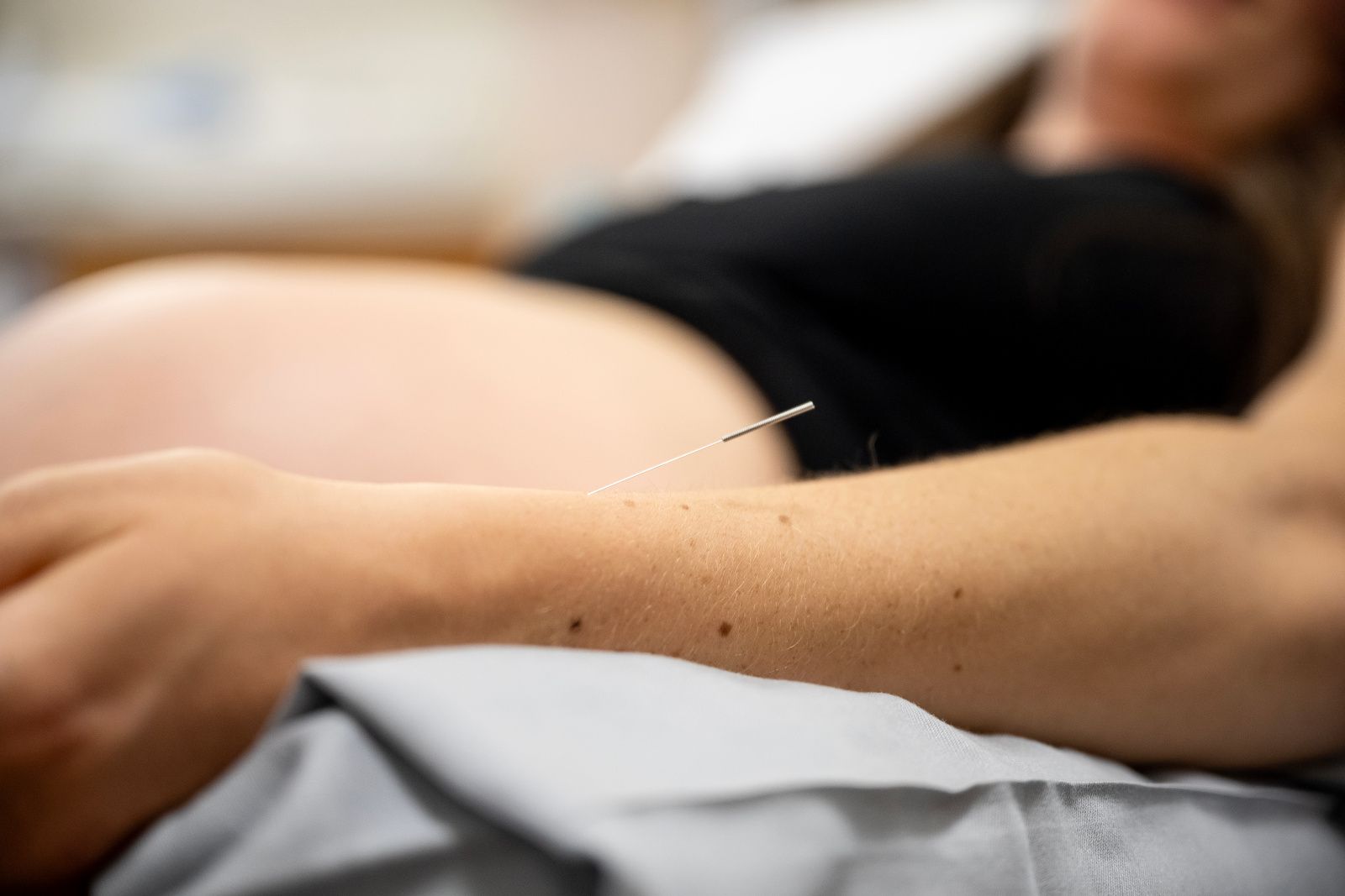 Schwangere mit Akupunkturnadeln im Arm. Fokus auf Arm.