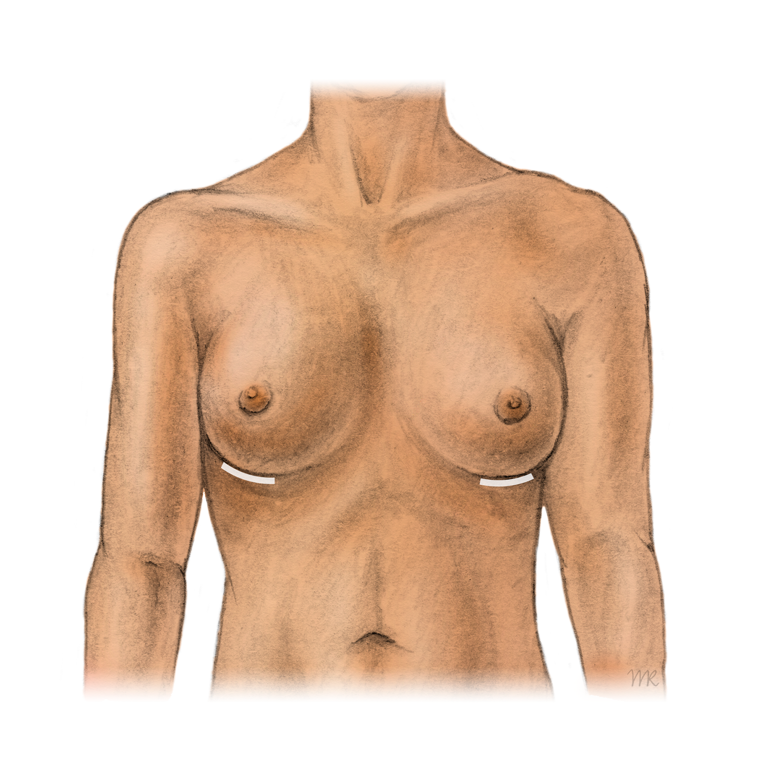 Brustvergrösserung mit Silikonimplantaten