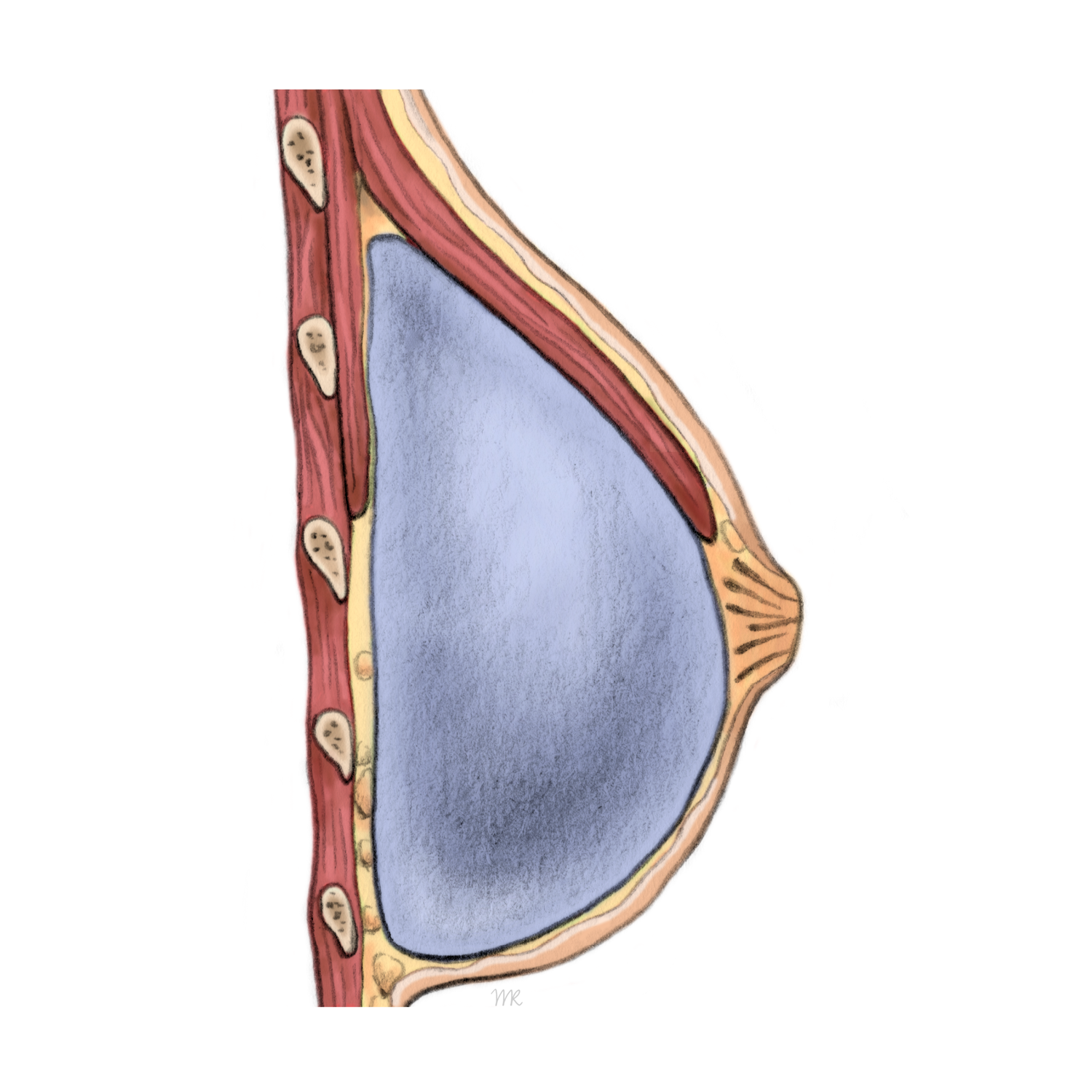 Silikonimplantat unter dem Brustmuskel