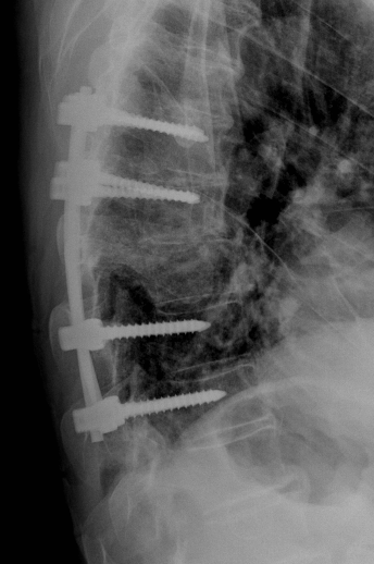 Röntgenbild nach Versorgung eines Brustwirbelbruchs mit Schrauben und Stangen