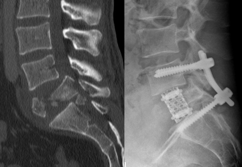 Computertomographie und Röntgenbild einer Wirbelsäule mit Schrauben 
