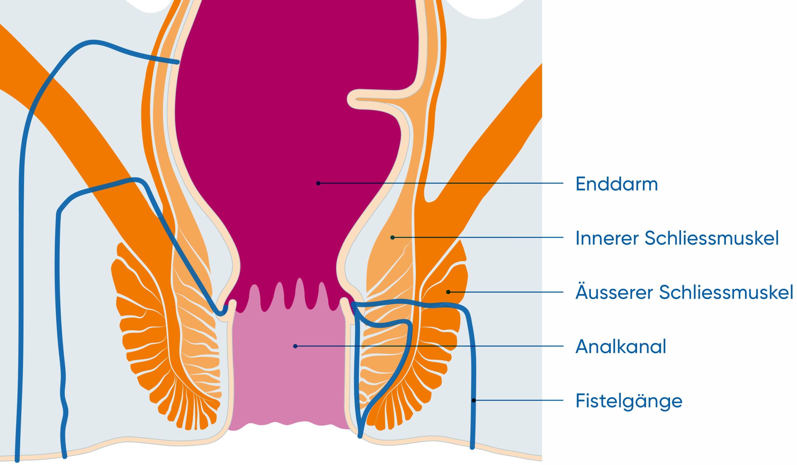 Analfisteln sind krankhafte Gänge, die den Analkanal mit der Körperoberfläche am After verbinden.