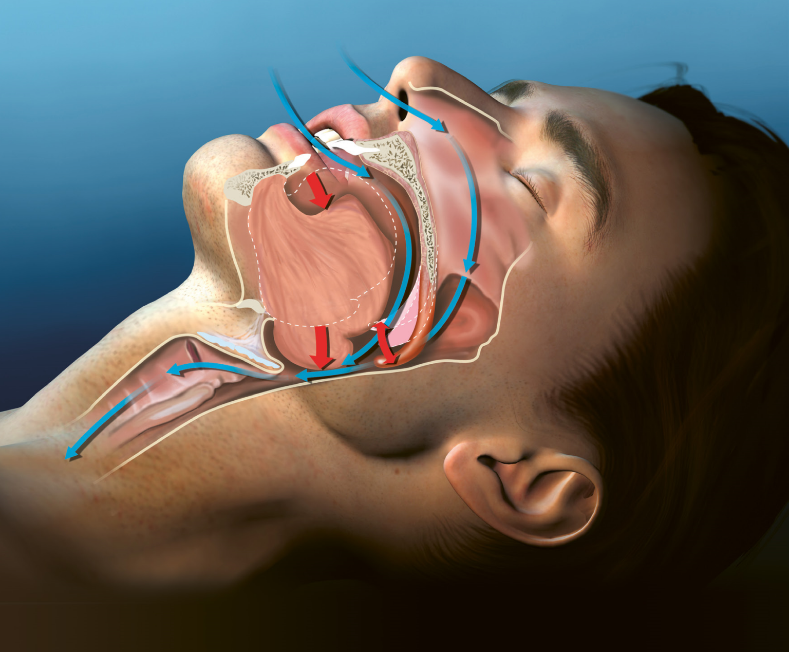 Obstruktives Schlaf Apnoe Syndrom Universit tsspital Z rich