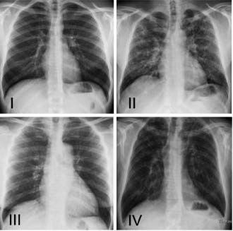 Röntgenaufnahmen einer Lunge mit Sarkoidose