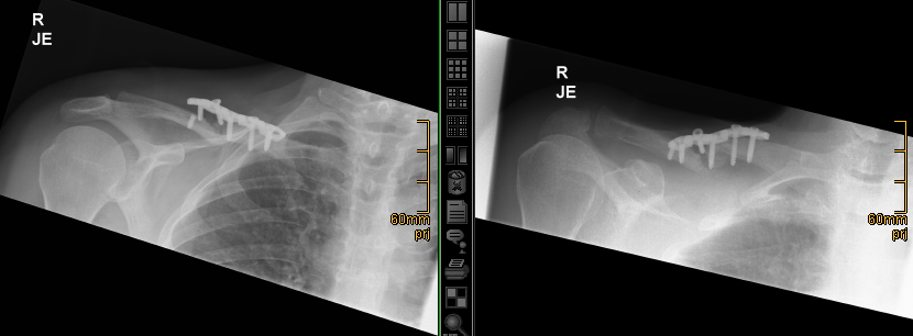 Plate broken and pulled away from the clavicle