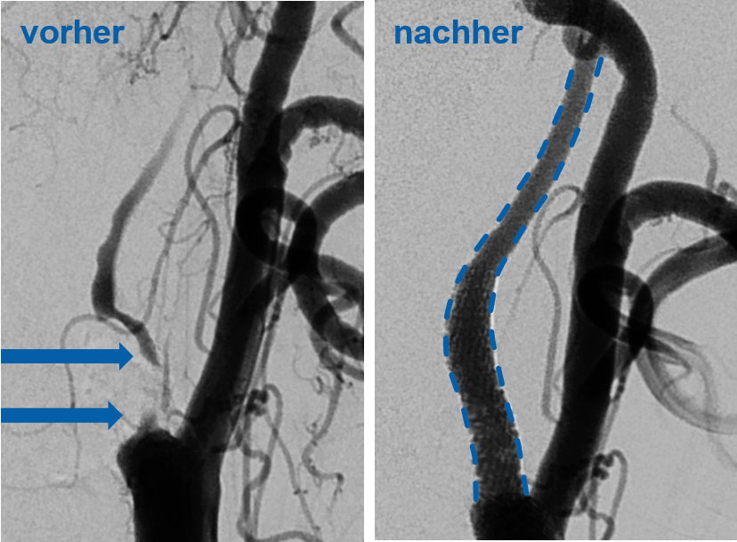 Links: blockierte Halsschlagader, rechts: Nach der Stent-Behandlung ist der Blutfluss wiederhergestellt.
