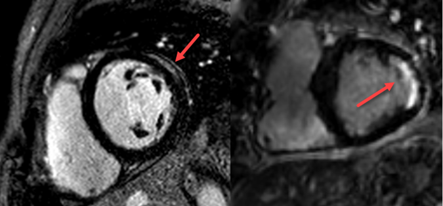 Herz-Magnetresonanztomographie (MRI) 35-jähriger Patient mit unklaren Brustschmerzen