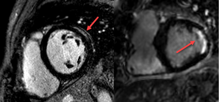 Cardiac magnetic resonance imaging (MRI) 35-year-old patient with unexplained chest pain