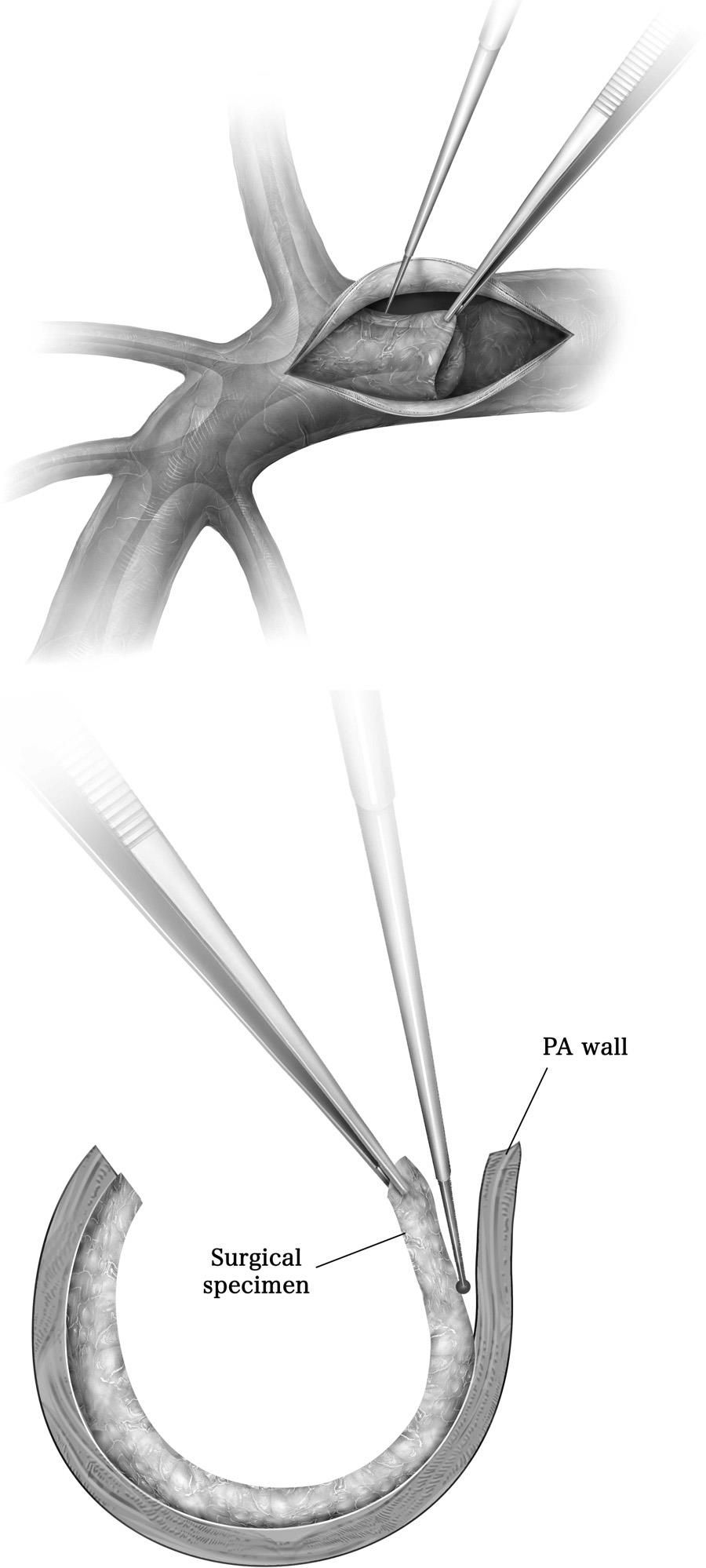 Illustration Ausschälen von Material während einer pulmonalen Endarteriektomie 