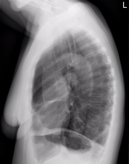 Röntgen-Übersichtsdarstellung des Brustkorbes bei COPD