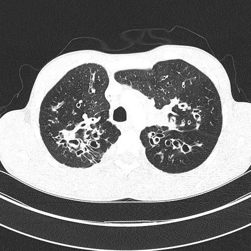 CT-Thorax: Erkennbare Bronchiektasen bei Zystischer Fibrose