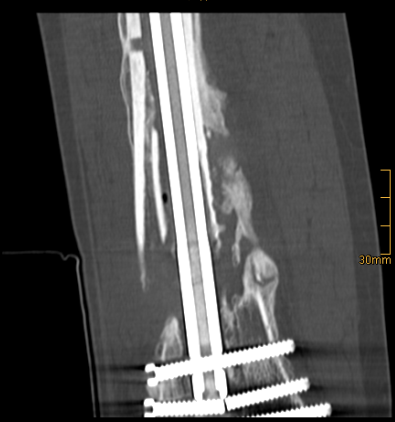  Die CT Bilder zeigen eine Knochenlücke und einen Schraubenbruch