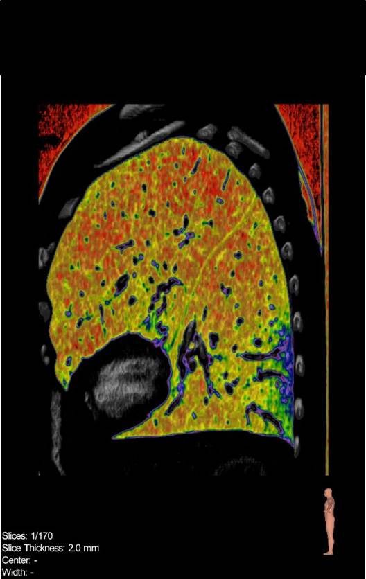 Computertomographie der Lunge bei COPD