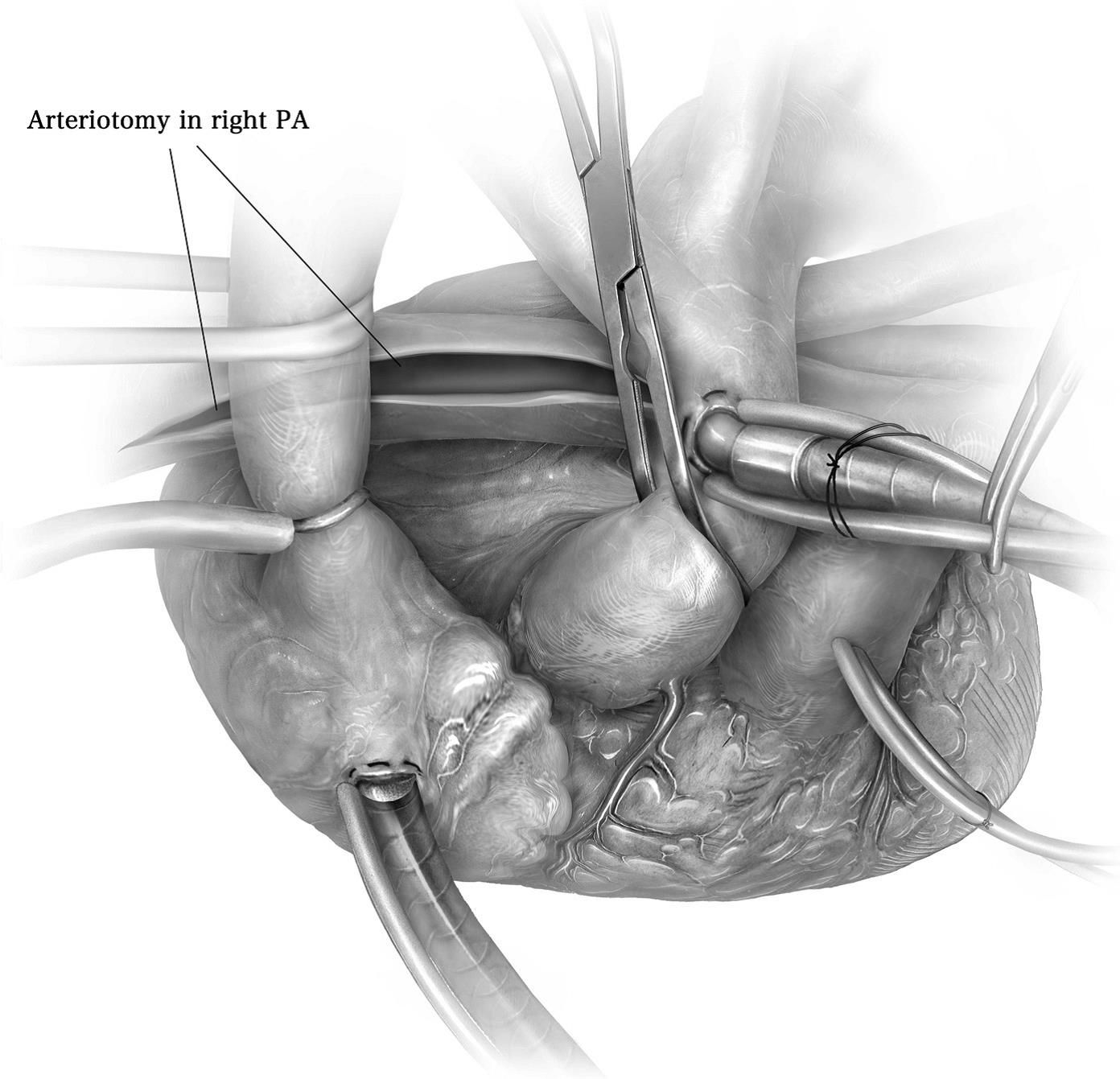 Illustration Endarteriektomie der rechten Pulmonalarterie