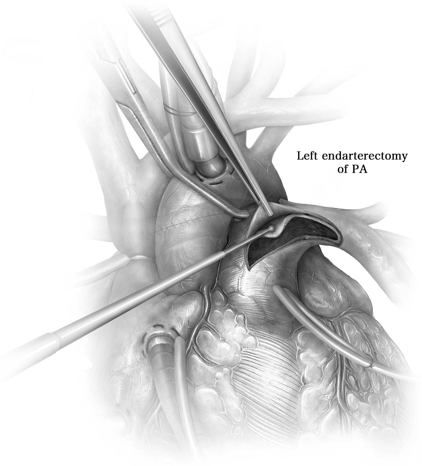 Illustration Endarterektomie der linken Pulmonalarterie