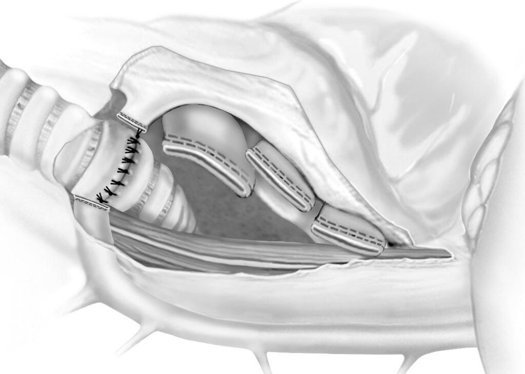 Illustration der Sleeve-Pneumonektomie