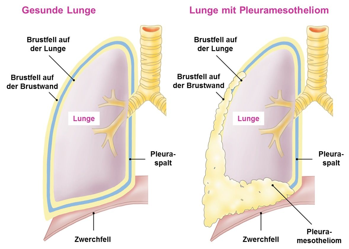 Illustration gesunde Lunge verglichen mit Lunge mit Pleuramesotheliom