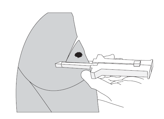 Illustration der Lungensegmentresektions-Technik