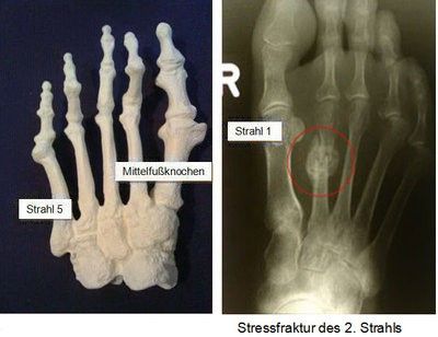 Radiograph of the stress fracture of the 2nd ray