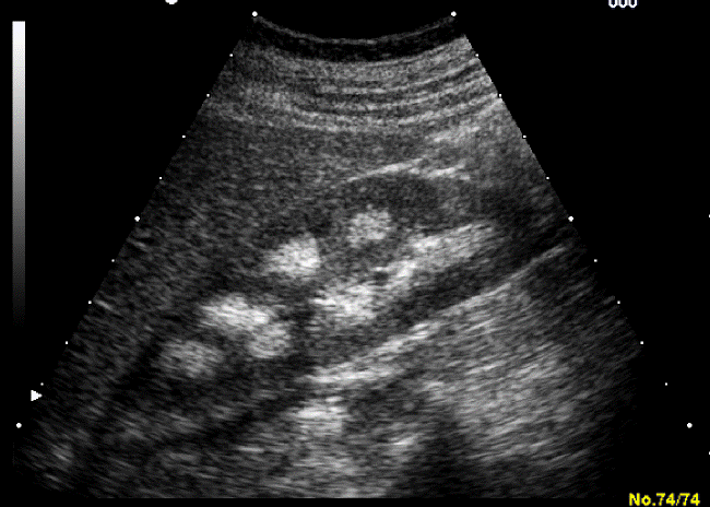 Ultrasound image of kidney stones