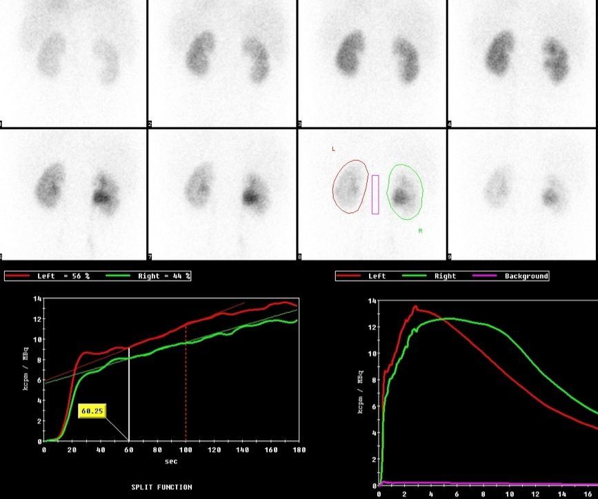 Figure: Renal scintigraphy with MAG3.