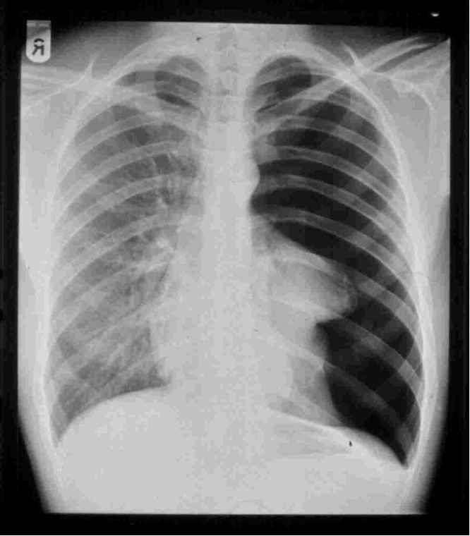 otalkollaps der linken Lungenseite im Sinne eines Pneumothorax in einer Röntgenaufnahme im Stehen in a.p-Technik.