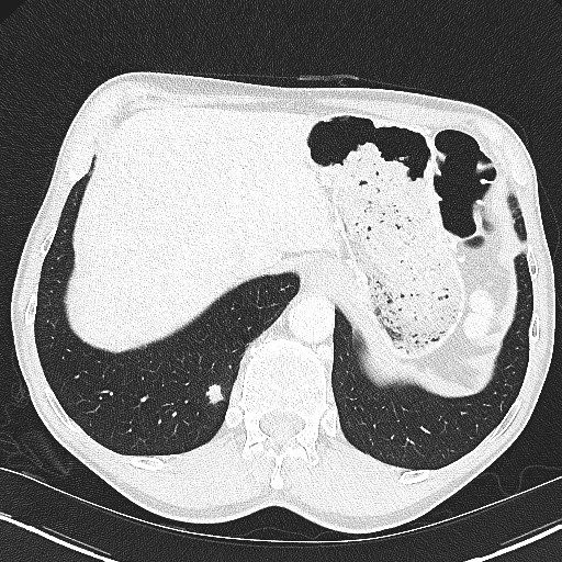 CT-Aufnahme solitäre Lungeherde Metastase