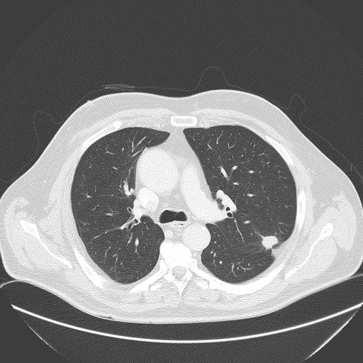 CT-Aufnahme solitäre Lungeherde Bronchuskarzinom
